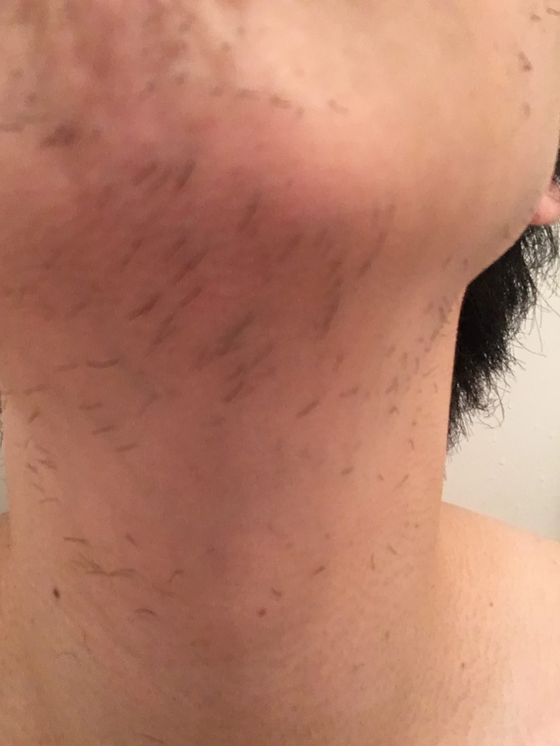 髭ドナー 植毛 自毛植毛なんでも相談室 植毛ブログ 薄毛の疑問にお答えします