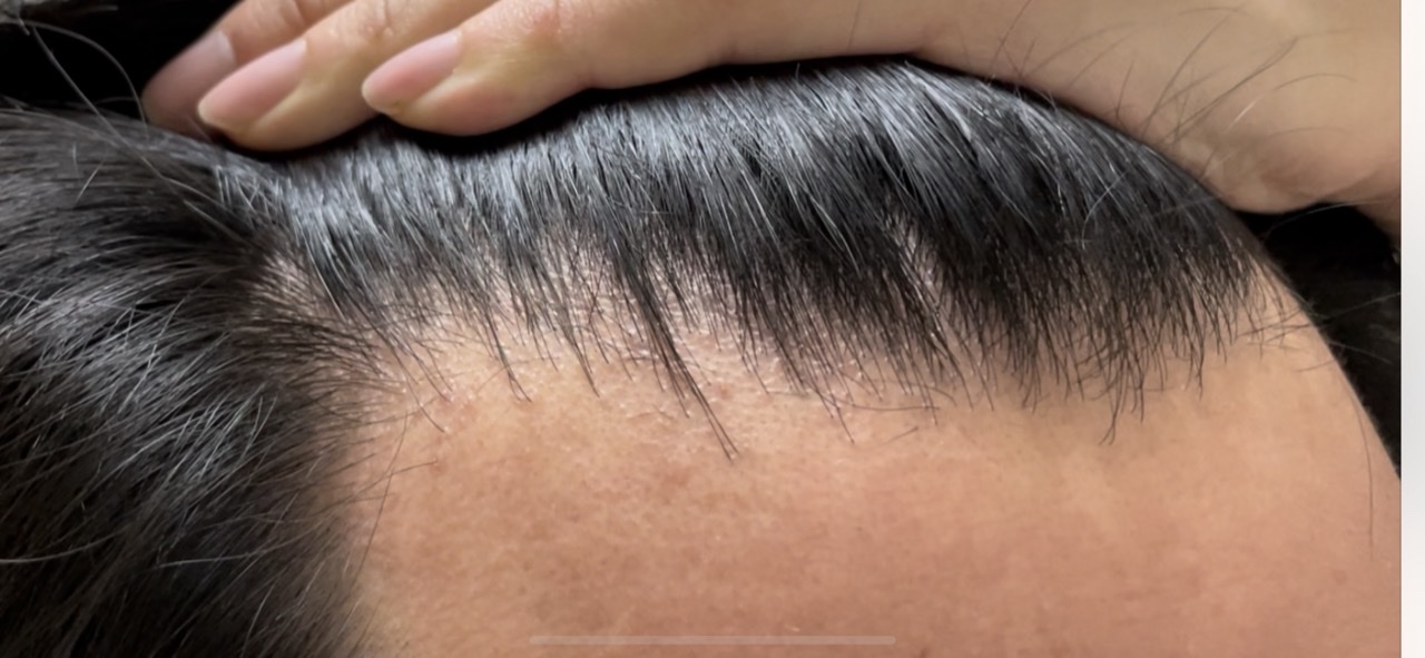 ギザギザした生え際 植毛 自毛植毛なんでも相談室 植毛ブログ 薄毛の疑問にお答えします