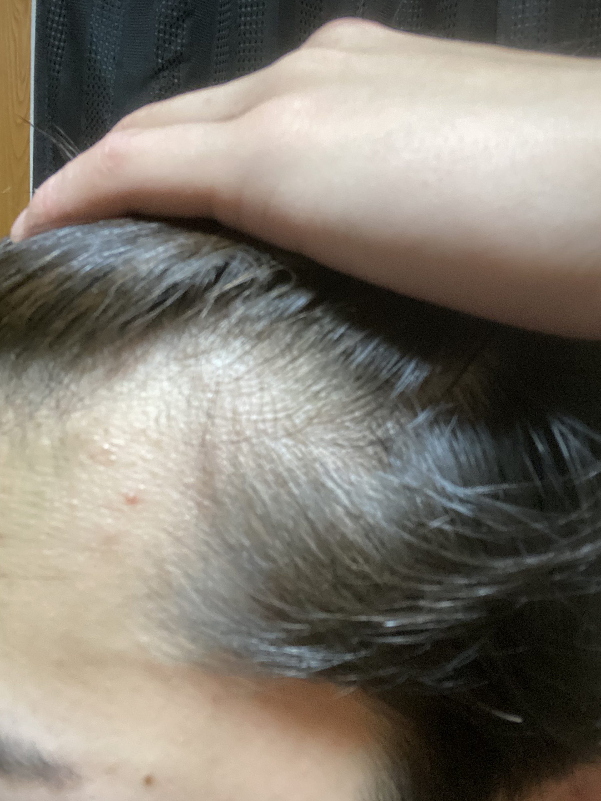 植毛 自毛植毛なんでも相談室 植毛ブログ 薄毛の疑問にお答えします