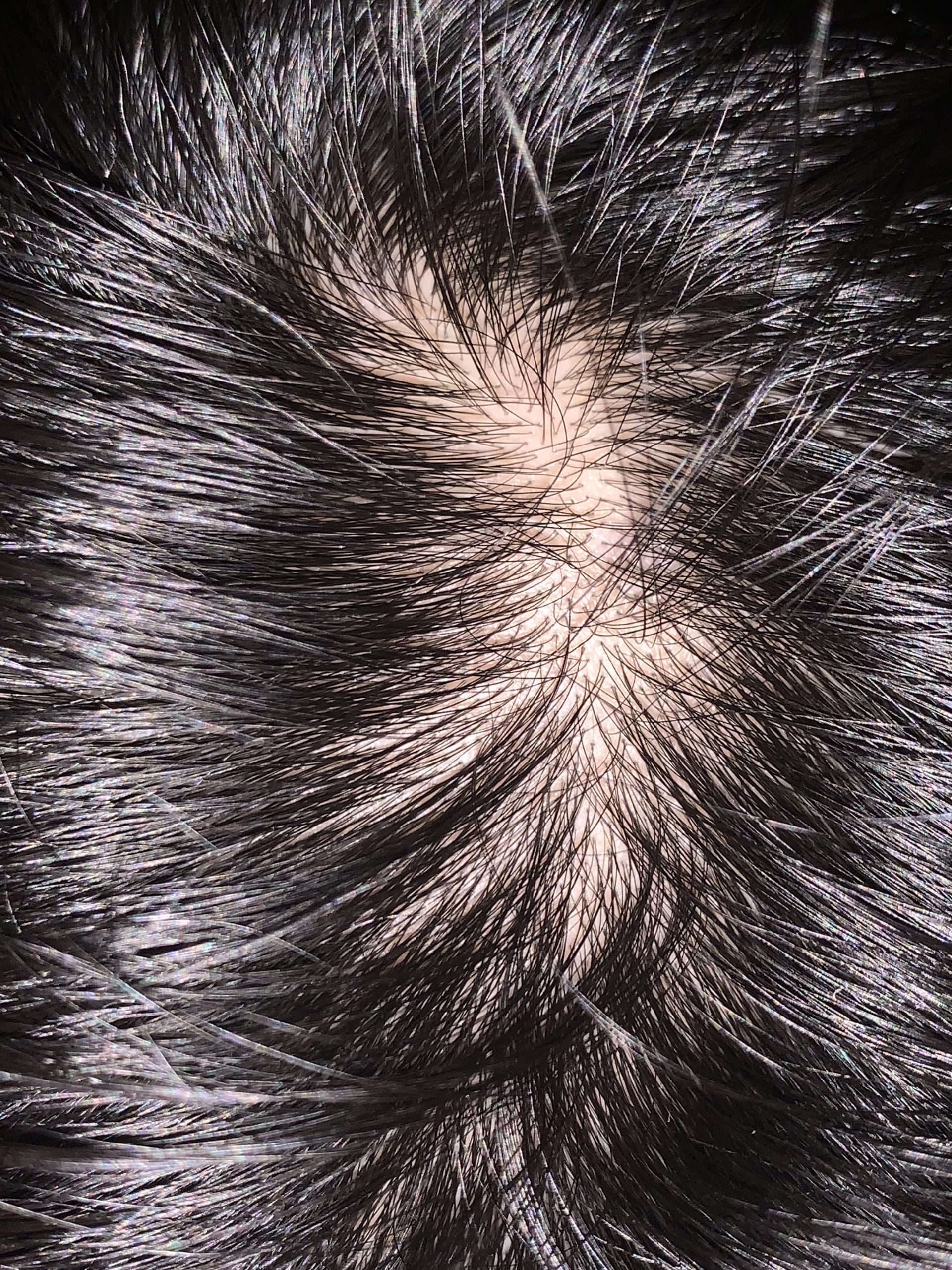 植毛による透け感改善について 植毛 自毛植毛なんでも相談室 植毛ブログ 薄毛の疑問にお答えします