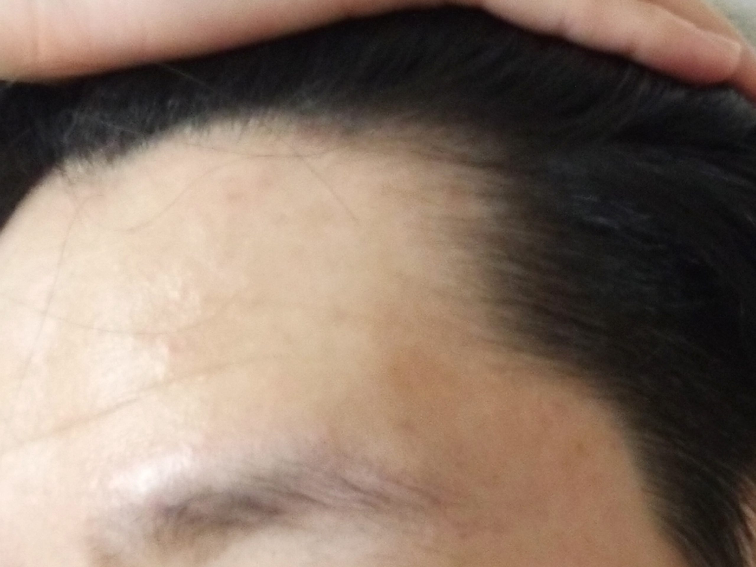 大学生 おでこハゲについて 植毛 自毛植毛なんでも相談室 植毛ブログ 薄毛の疑問にお答えします