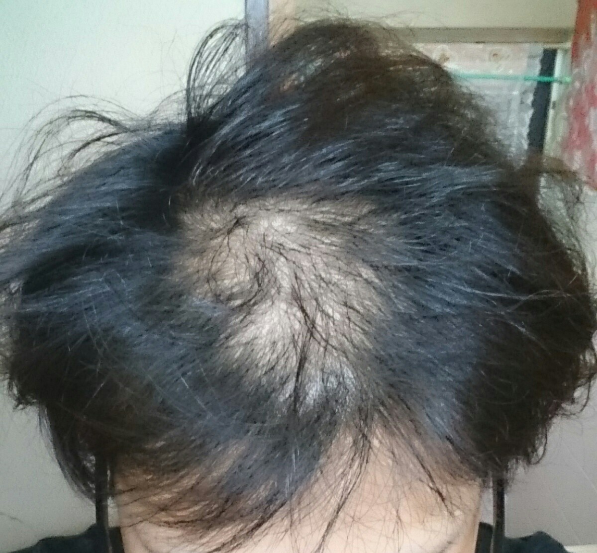 植毛 自毛植毛なんでも相談室 植毛ブログ 薄毛の疑問にお答えします