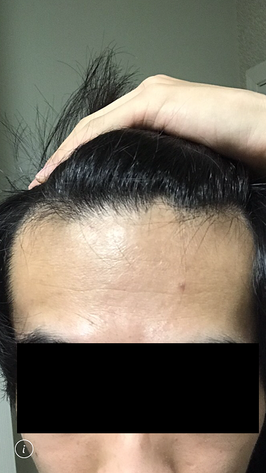 Agaの可能性はありますか 植毛 自毛植毛なんでも相談室 植毛ブログ 薄毛の疑問にお答えします