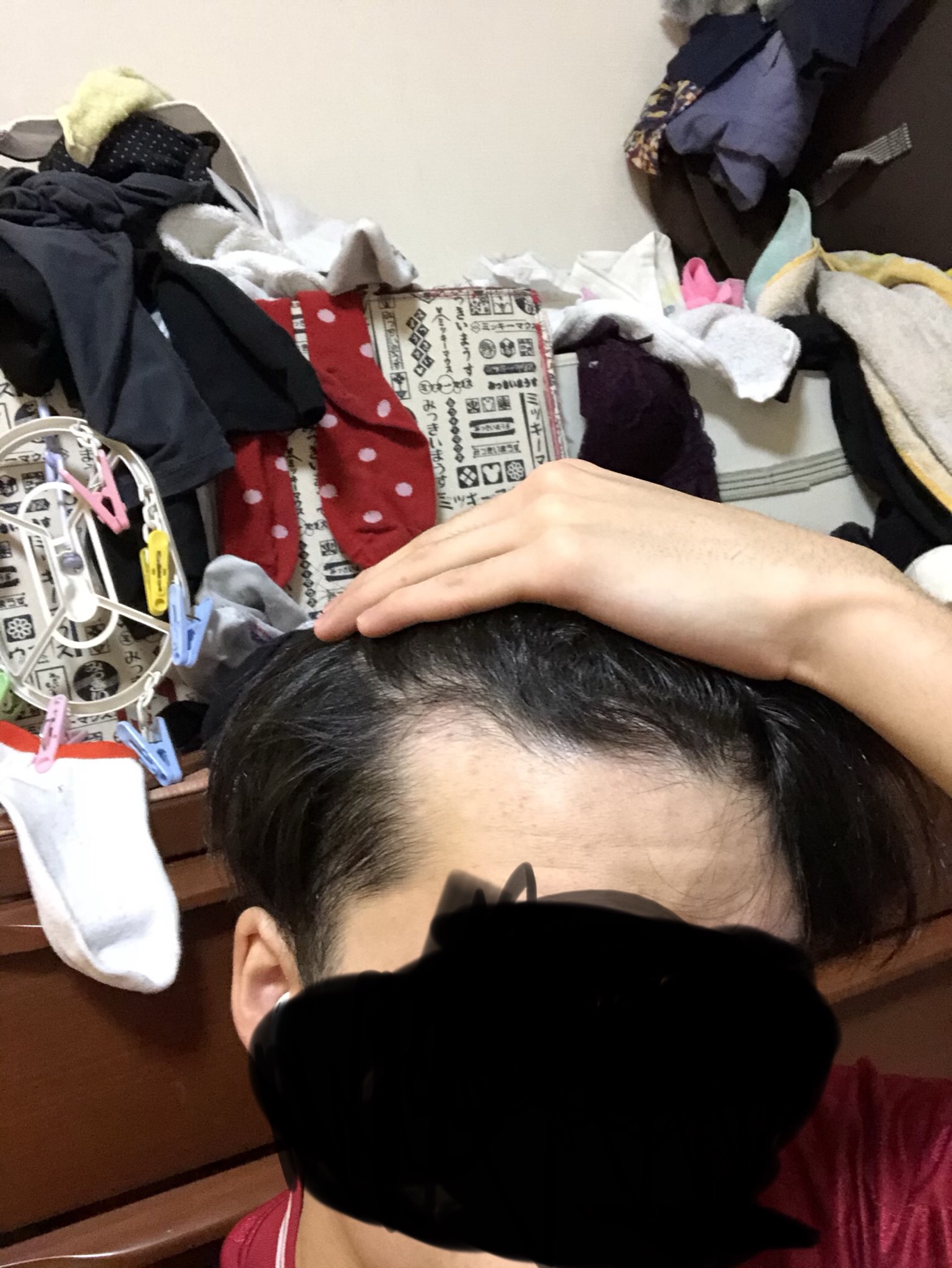 生え際後退でしょうか 植毛 自毛植毛なんでも相談室 植毛ブログ 薄毛の疑問にお答えします