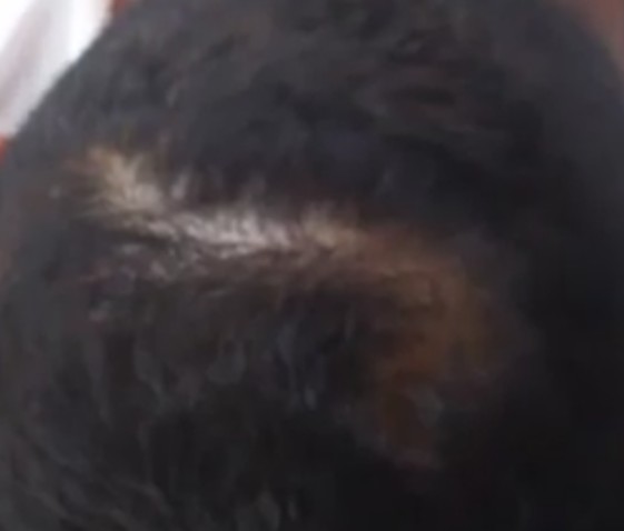 つむじの形について 植毛 自毛植毛なんでも相談室 植毛ブログ 薄毛の疑問にお答えします