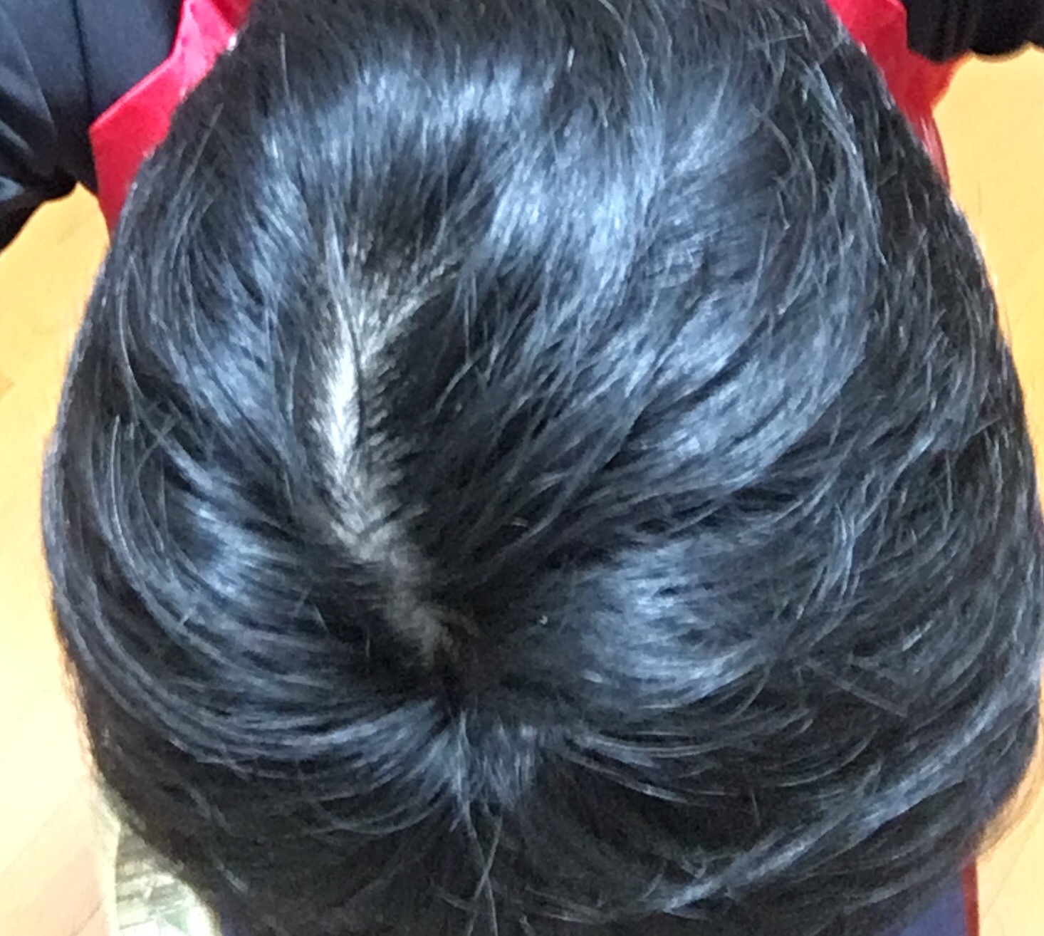 つむじ割れについて 植毛 自毛植毛なんでも相談室 植毛ブログ 薄毛の疑問にお答えします