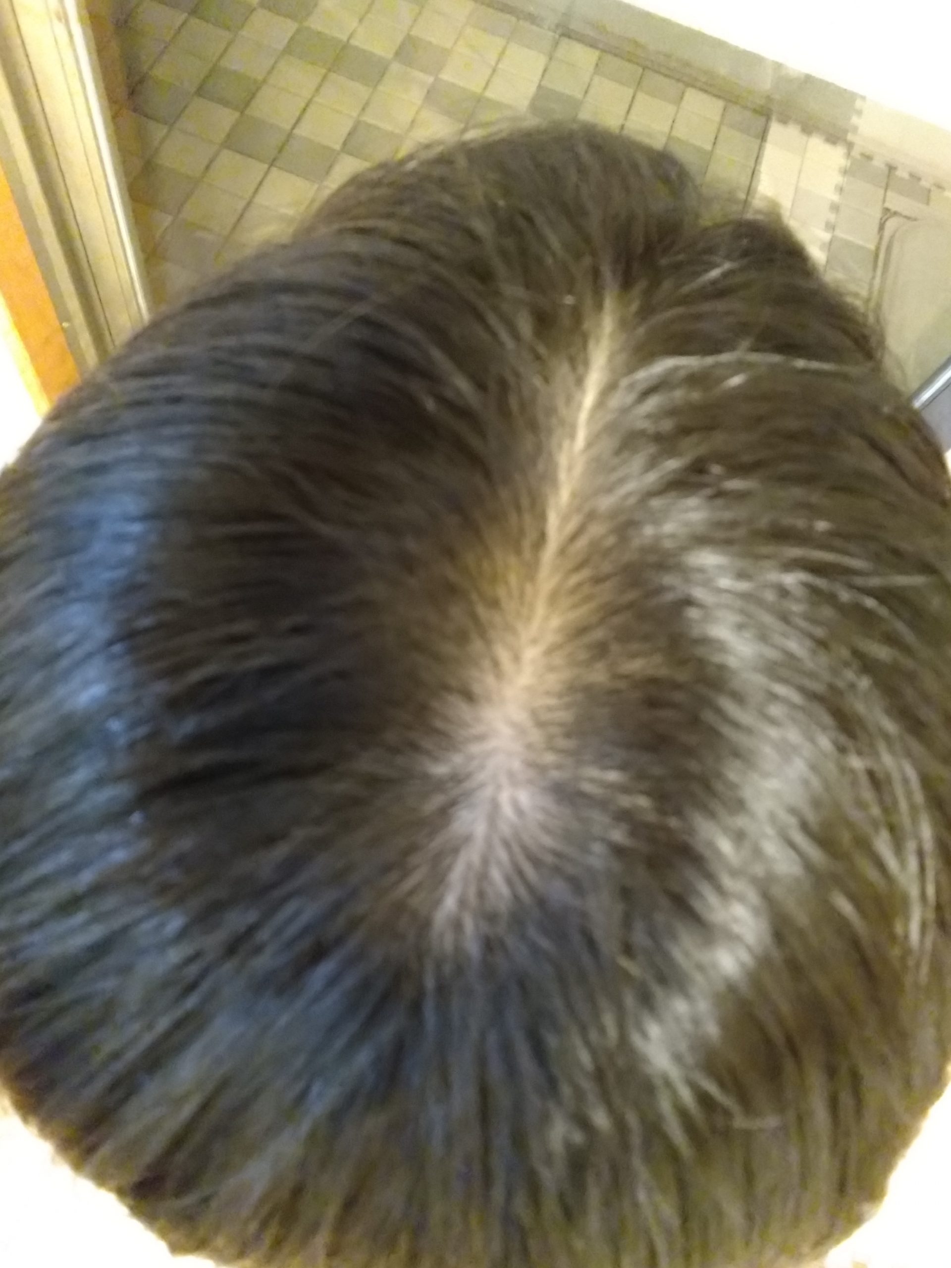 女性のつむじ植毛 植毛 自毛植毛なんでも相談室 植毛ブログ 薄毛の疑問にお答えします