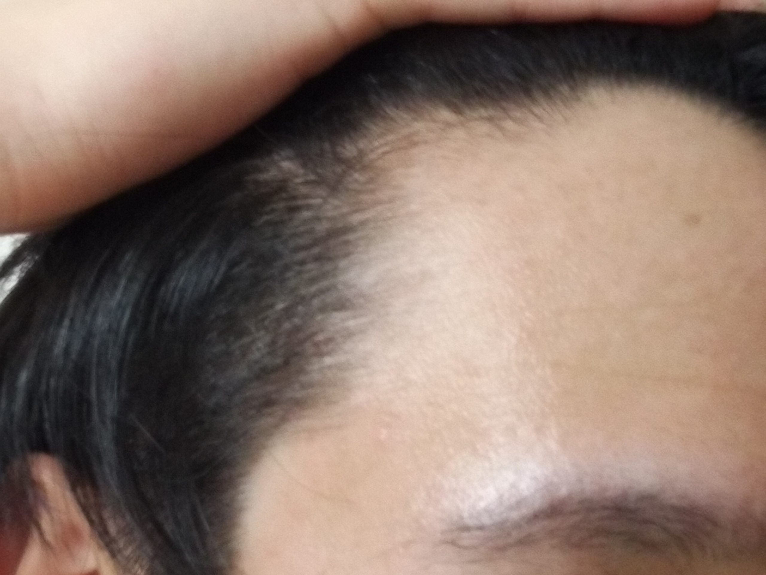 大学生 おでこハゲについて 植毛 自毛植毛なんでも相談室 植毛ブログ 薄毛の疑問にお答えします