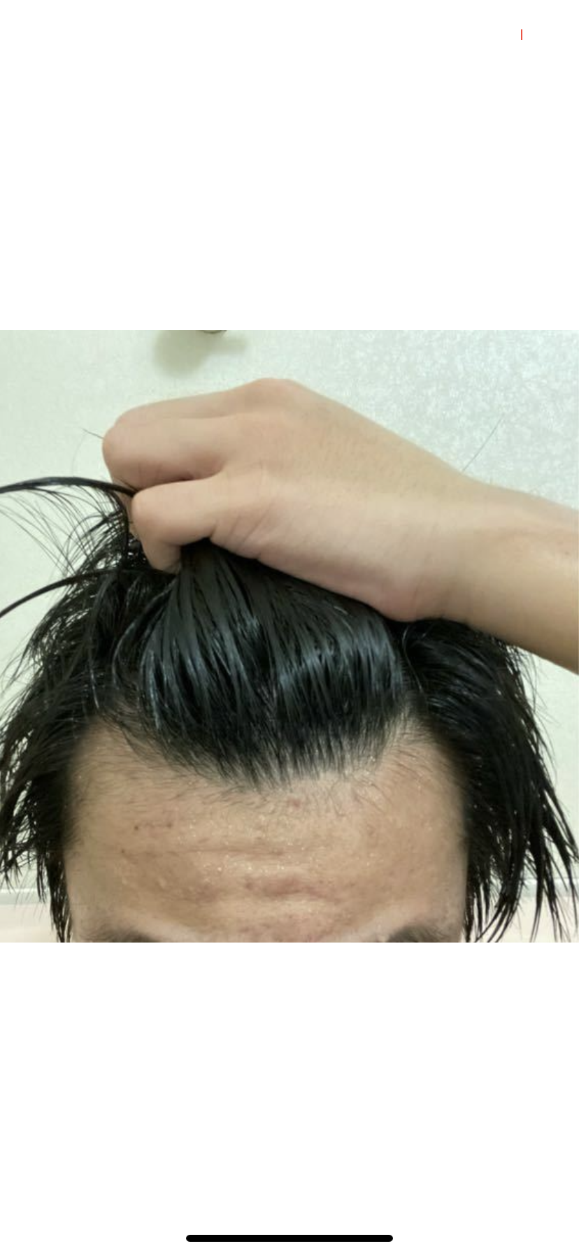 植毛 自毛植毛なんでも相談室 植毛ブログ 薄毛の疑問にお答えします