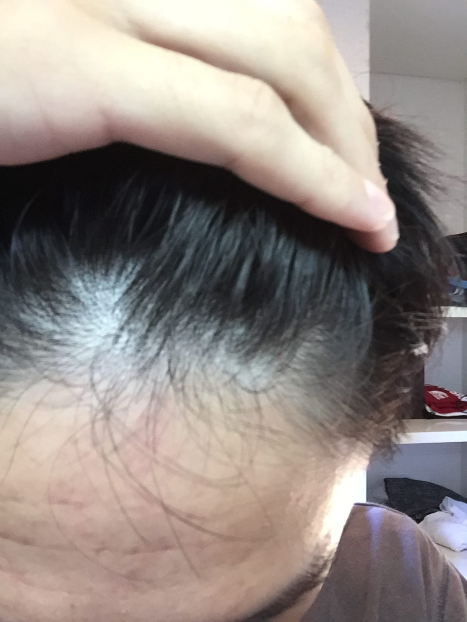 薄毛について 植毛 自毛植毛なんでも相談室 植毛ブログ 薄毛の疑問にお答えします