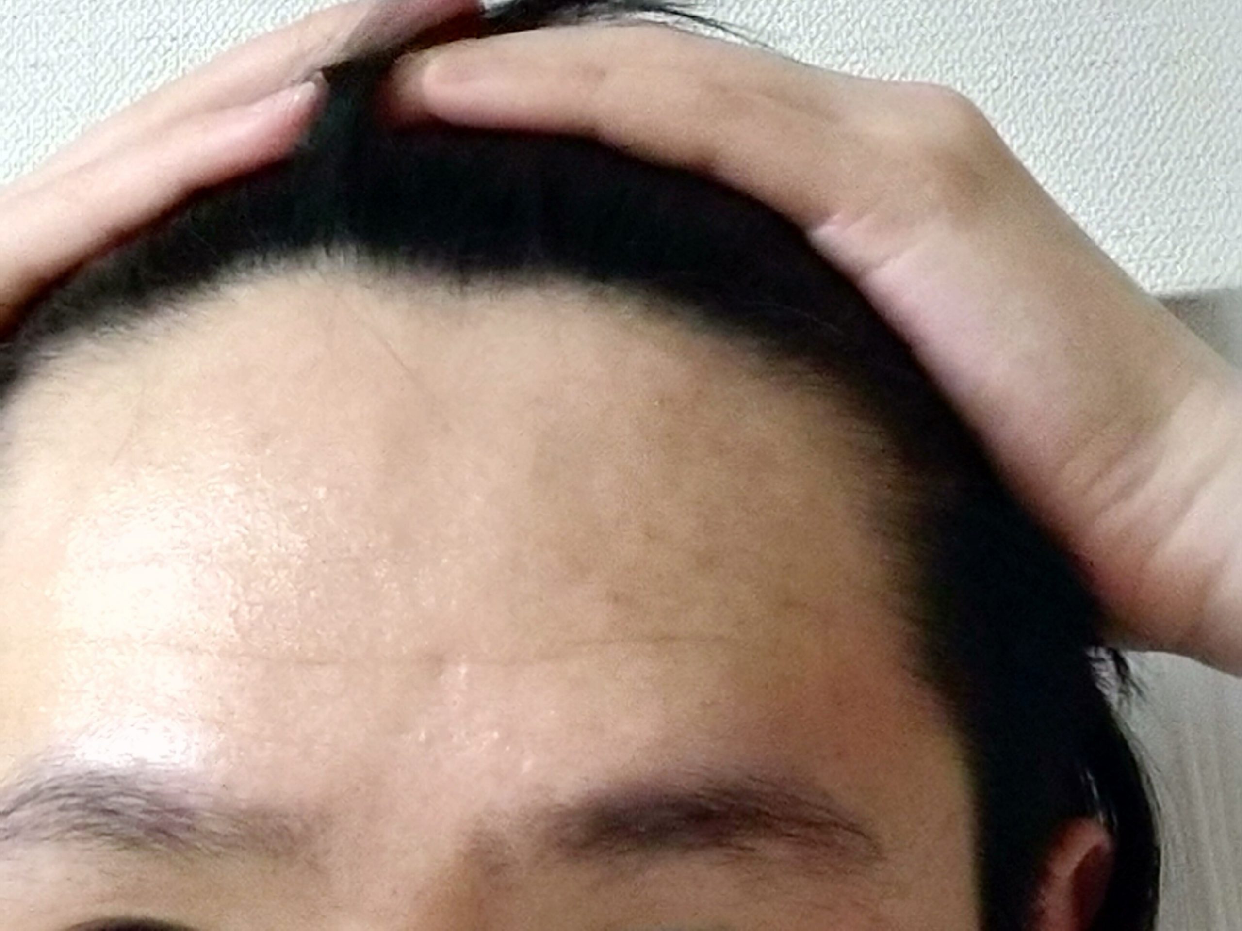 大学生 おでこハゲについて 植毛 自毛植毛なんでも相談室 植毛ブログ 薄毛の疑問にお答えします