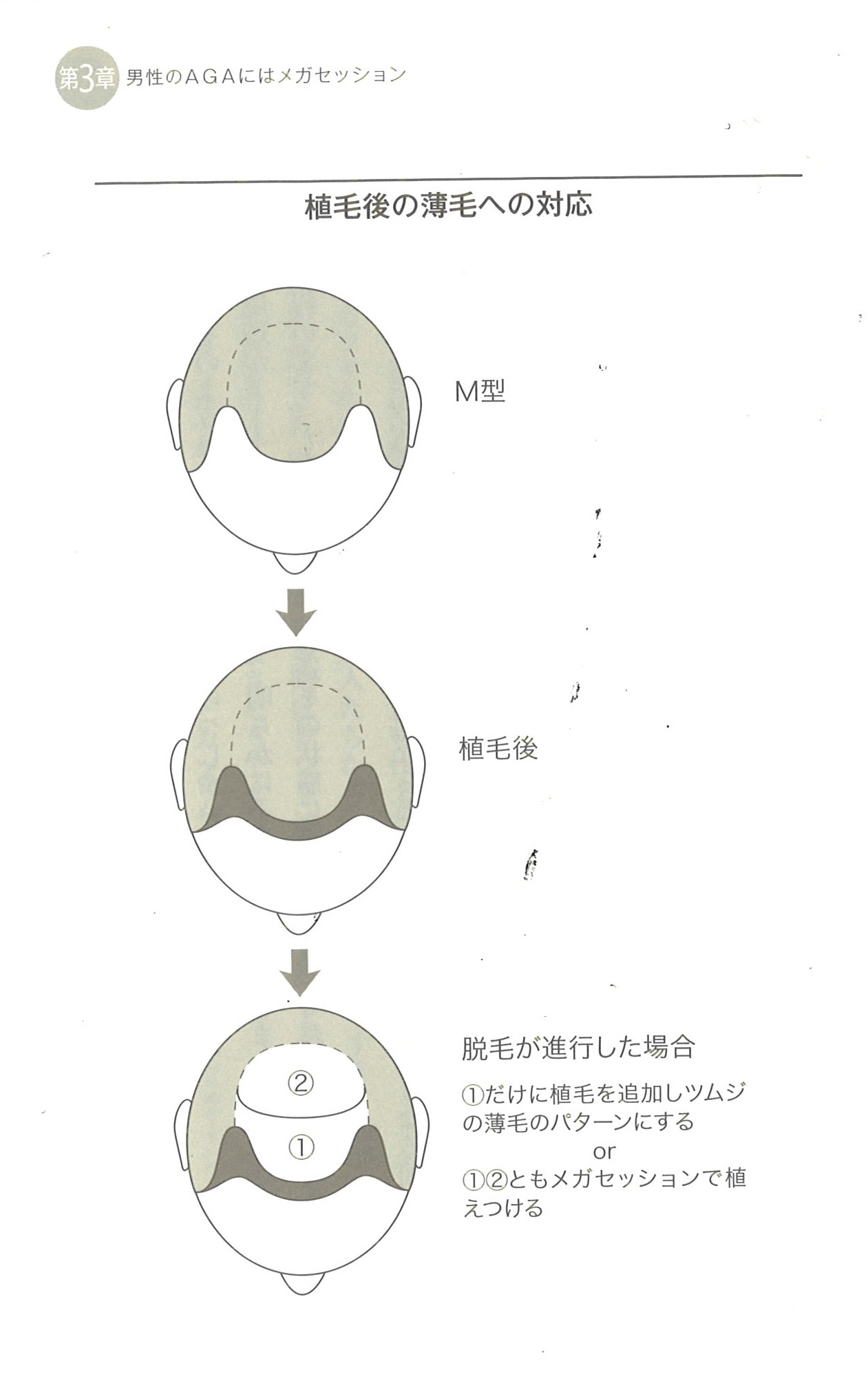 将来の対応について 植毛 自毛植毛なんでも相談室 植毛ブログ 薄毛の疑問にお答えします