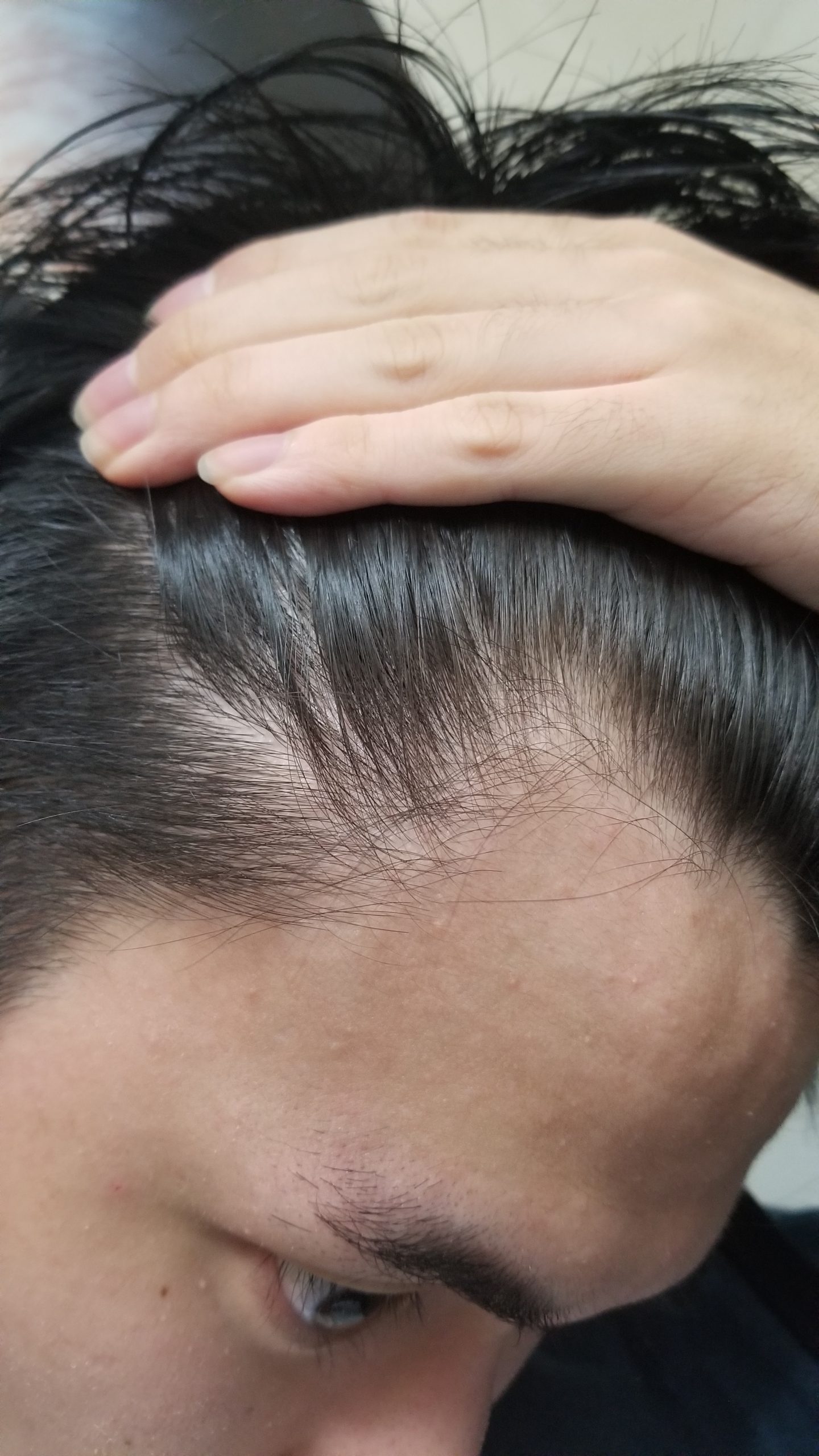 植毛 自毛植毛なんでも相談室 植毛ブログ 薄毛の疑問にお答えします