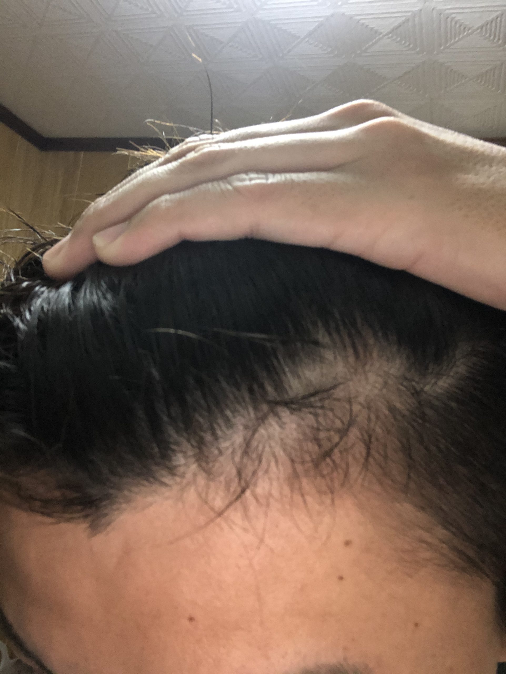 Agaかどうか 植毛 自毛植毛なんでも相談室 植毛ブログ 薄毛の疑問にお答えします