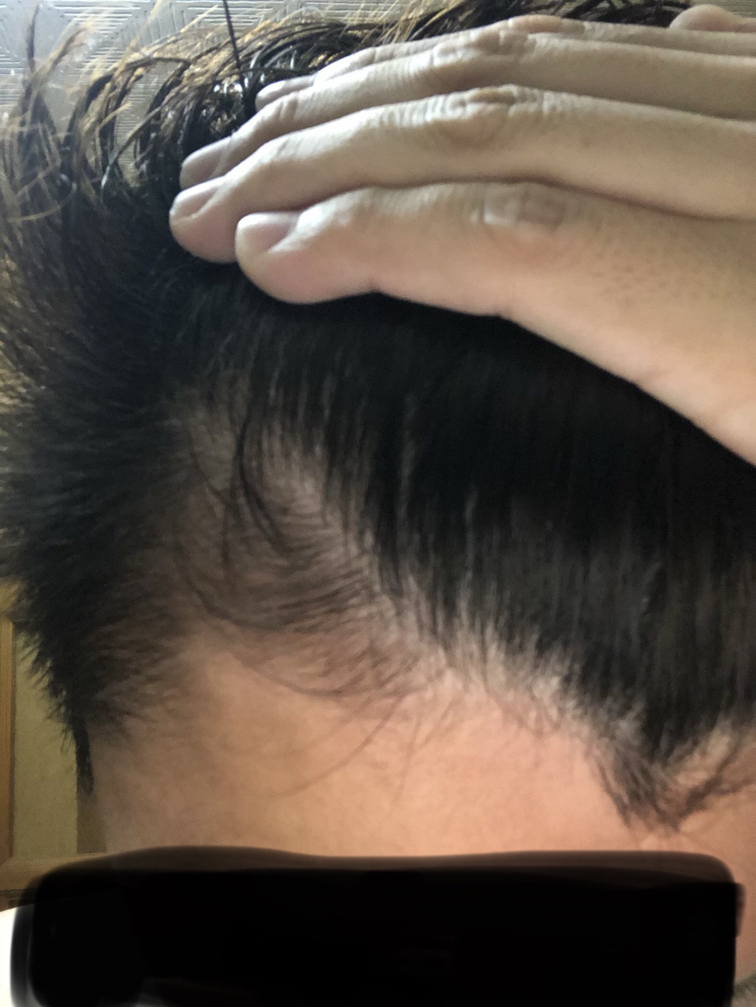 Agaかどうか 植毛 自毛植毛なんでも相談室 植毛ブログ 薄毛の疑問にお答えします