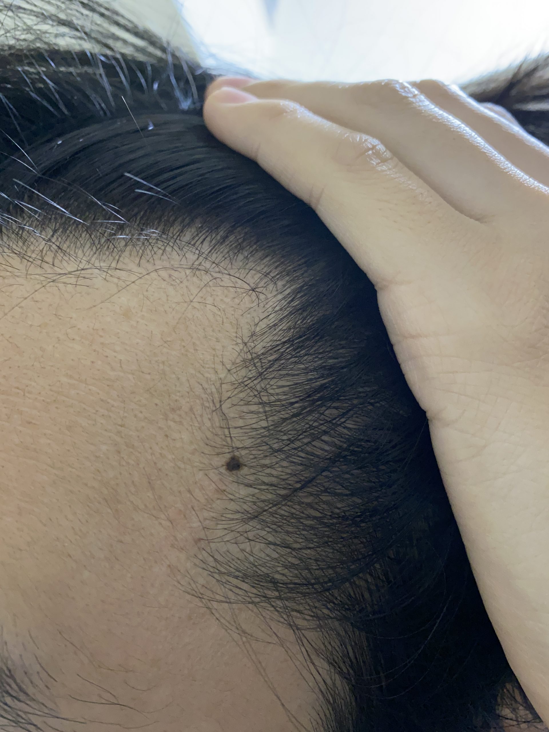 植毛 自毛植毛なんでも相談室 植毛ブログ 薄毛の疑問にお答えします