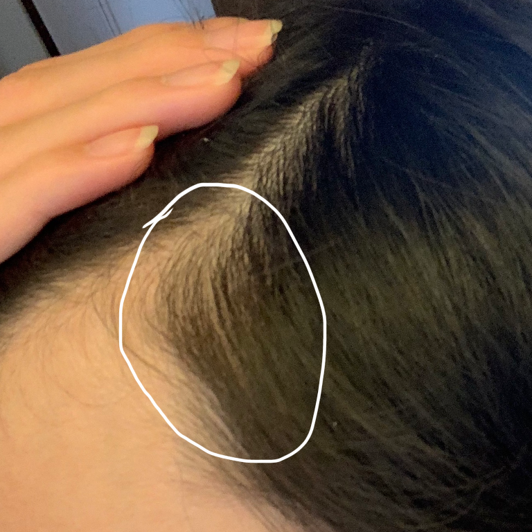 こめかみについて 植毛 自毛植毛なんでも相談室 植毛ブログ 薄毛の疑問にお答えします