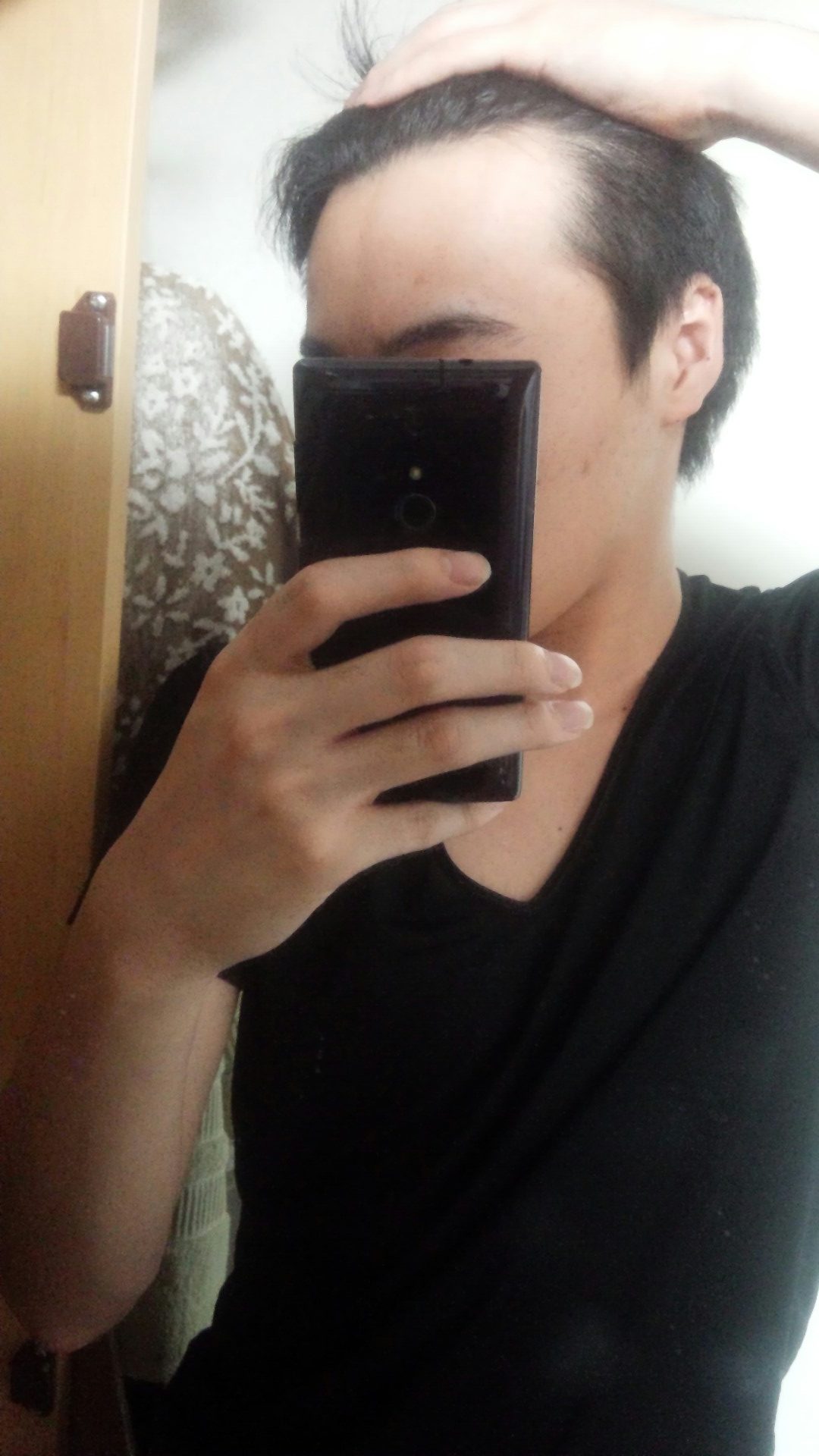 額への植毛について | 植毛・自毛植毛なんでも相談室・植毛 ...