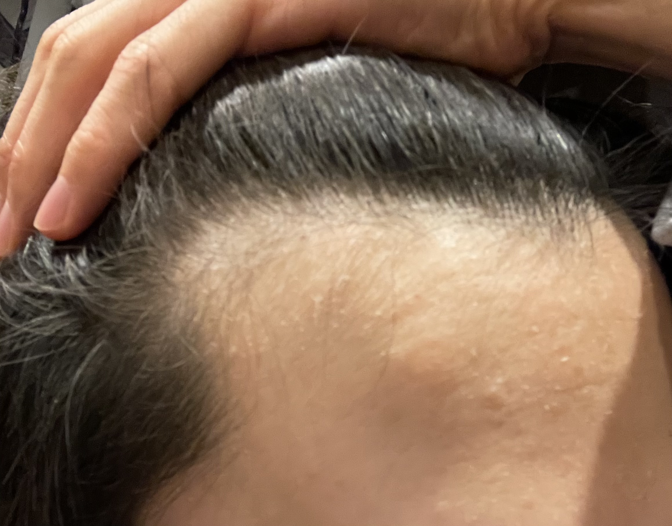 生え際と富士額の薄毛 植毛 自毛植毛なんでも相談室 植毛ブログ 薄毛の疑問にお答えします