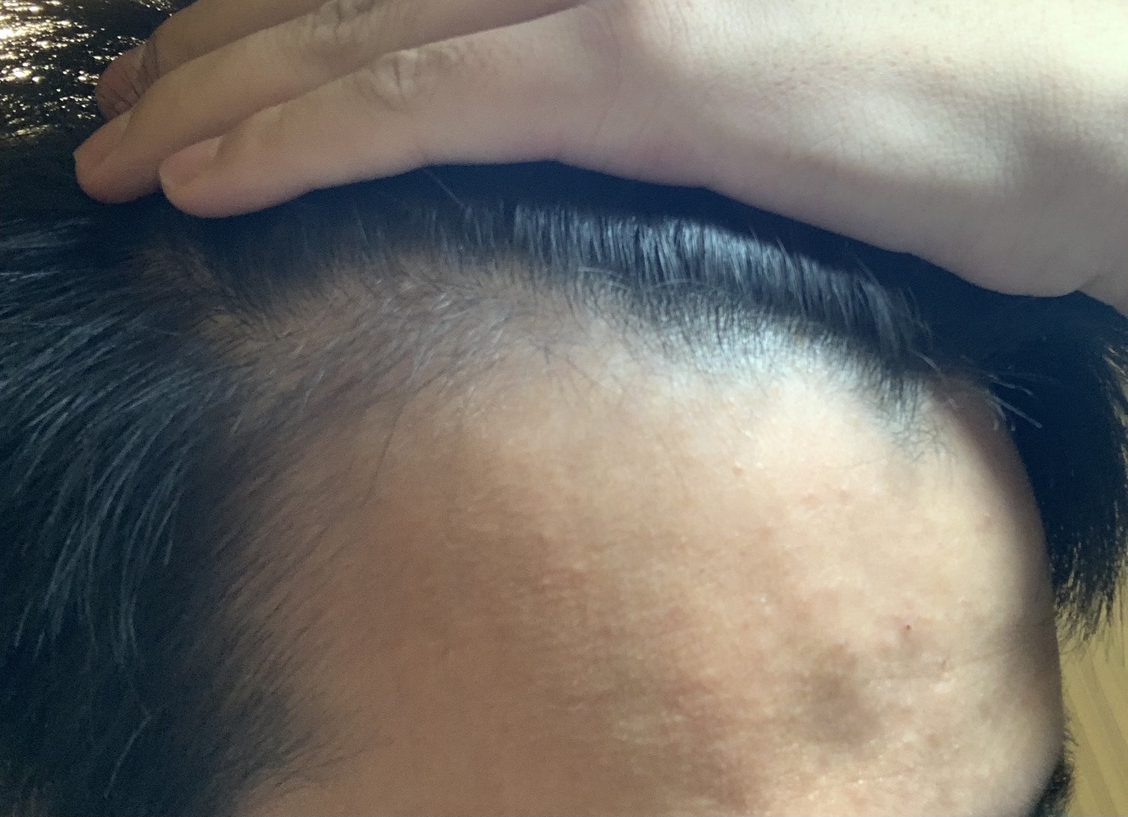 植毛 自毛植毛なんでも相談室 植毛ブログ 薄毛の疑問にお答えします