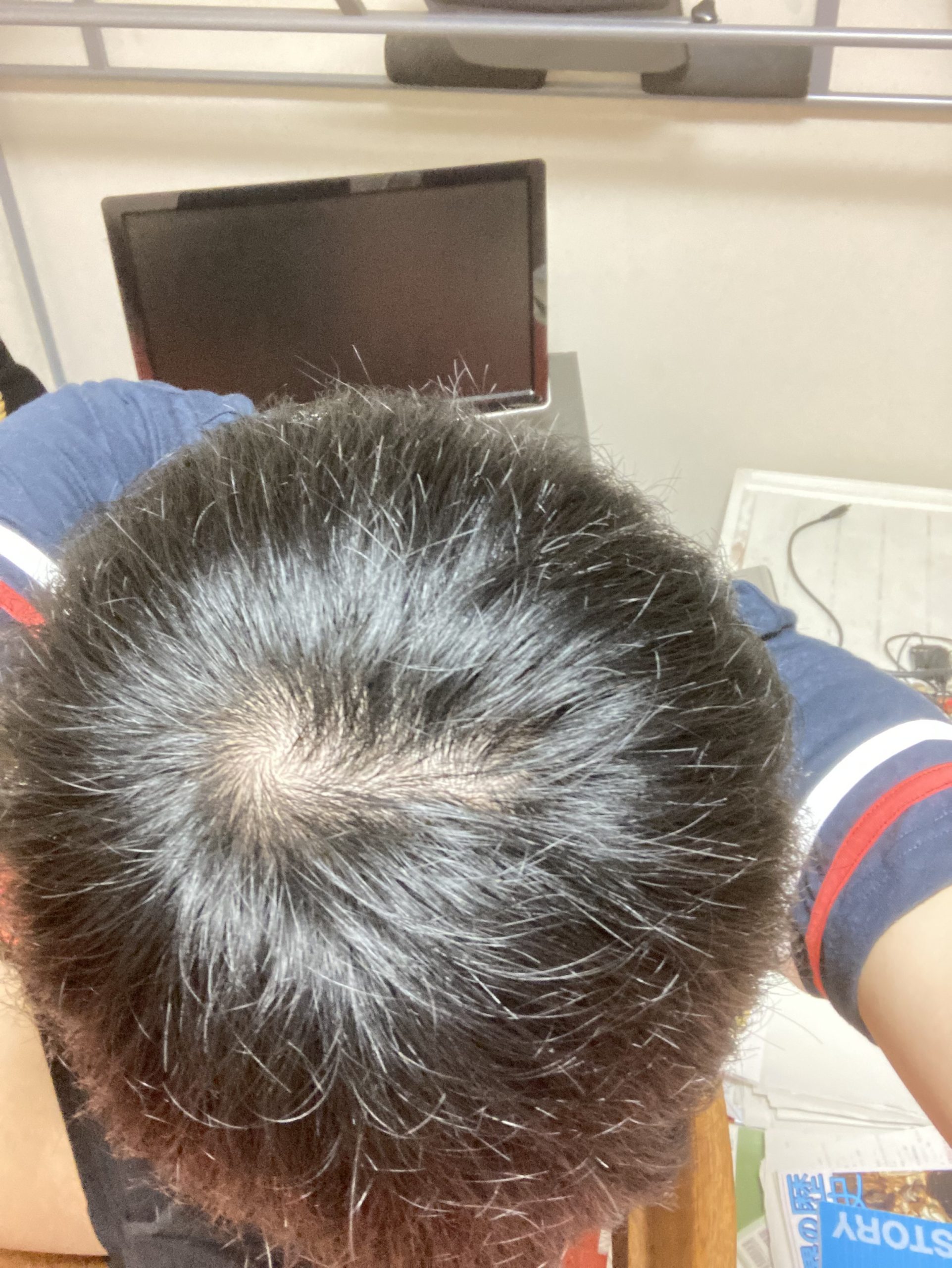 つむじはげ 植毛 自毛植毛なんでも相談室 植毛ブログ 薄毛の疑問にお答えします