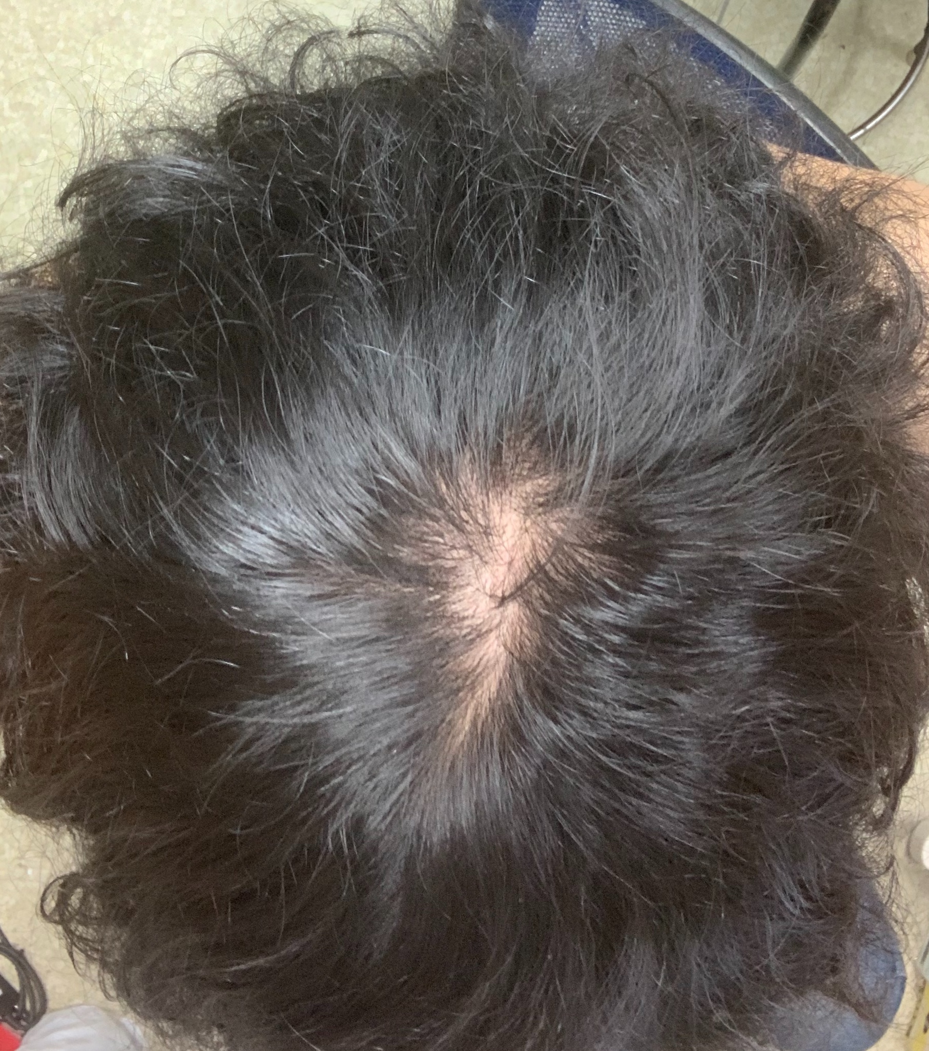 植毛 自毛植毛なんでも相談室 植毛ブログ 薄毛の疑問にお答えします