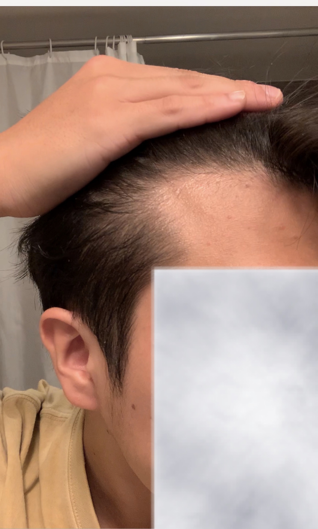 M字部分について 植毛 自毛植毛なんでも相談室 植毛ブログ 薄毛の疑問にお答えします