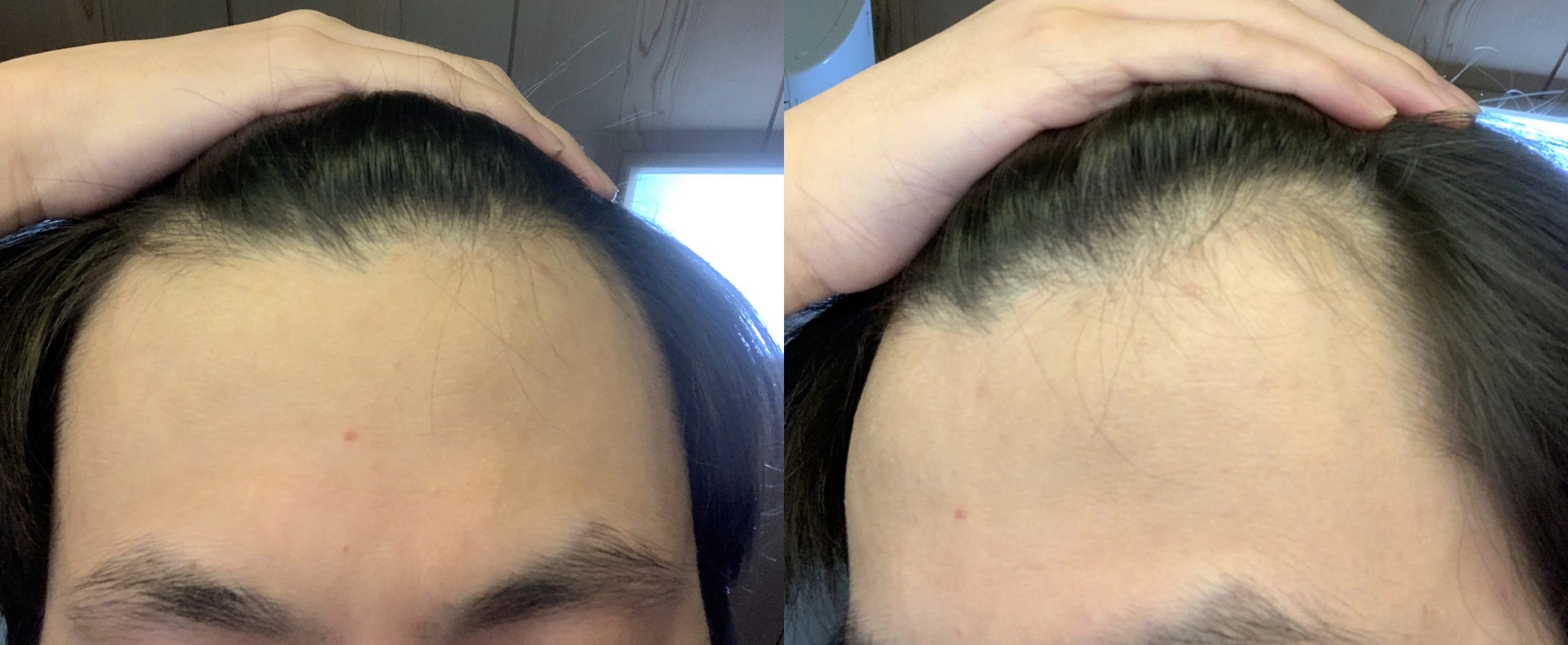 植毛 自毛植毛なんでも相談室 植毛ブログ 薄毛の疑問にお答えします