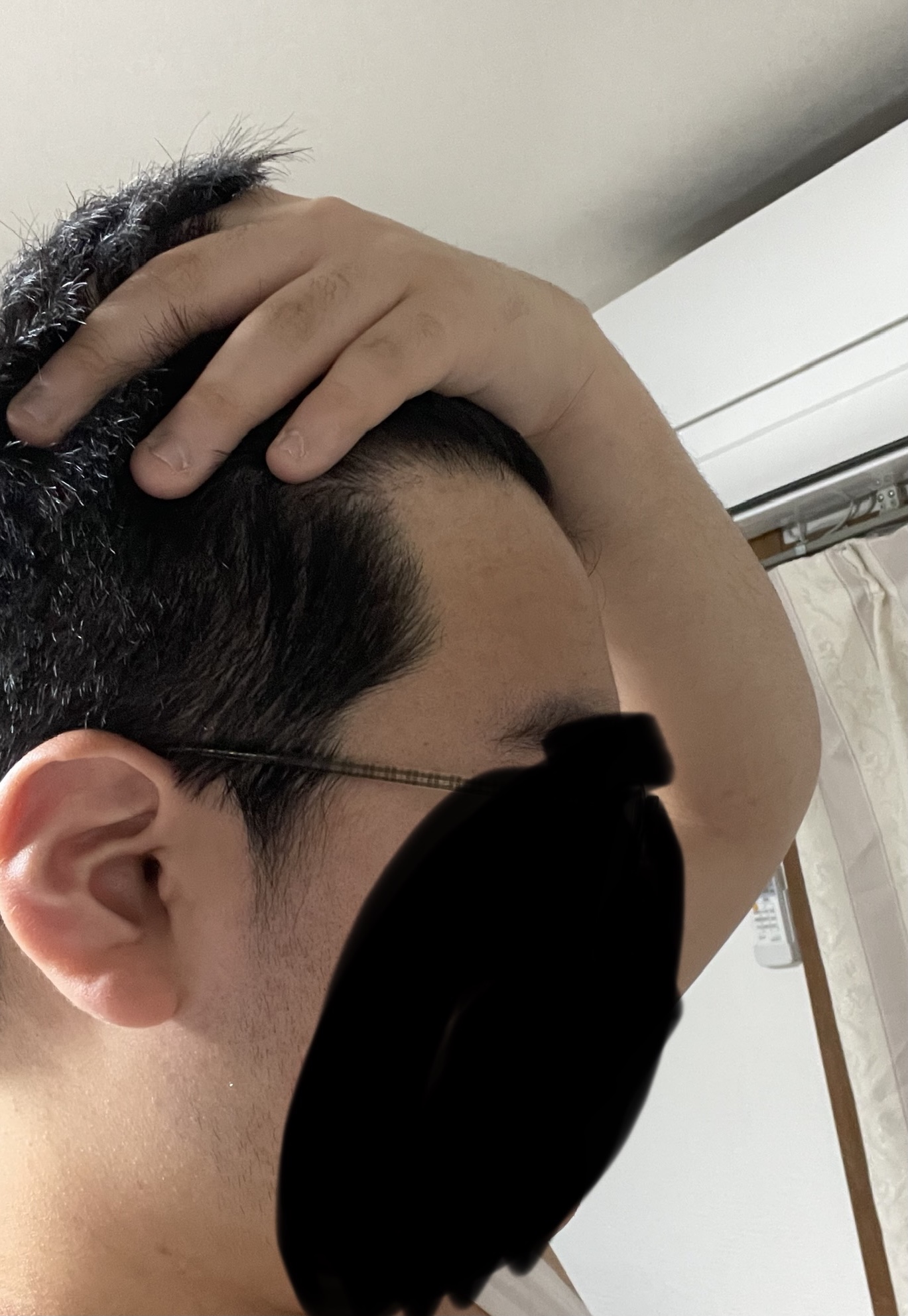 植毛 自毛植毛なんでも相談室 植毛ブログ 薄毛の疑問にお答えします