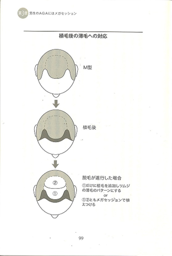 離れ小島 植毛 自毛植毛なんでも相談室 植毛ブログ 薄毛の疑問にお答えします