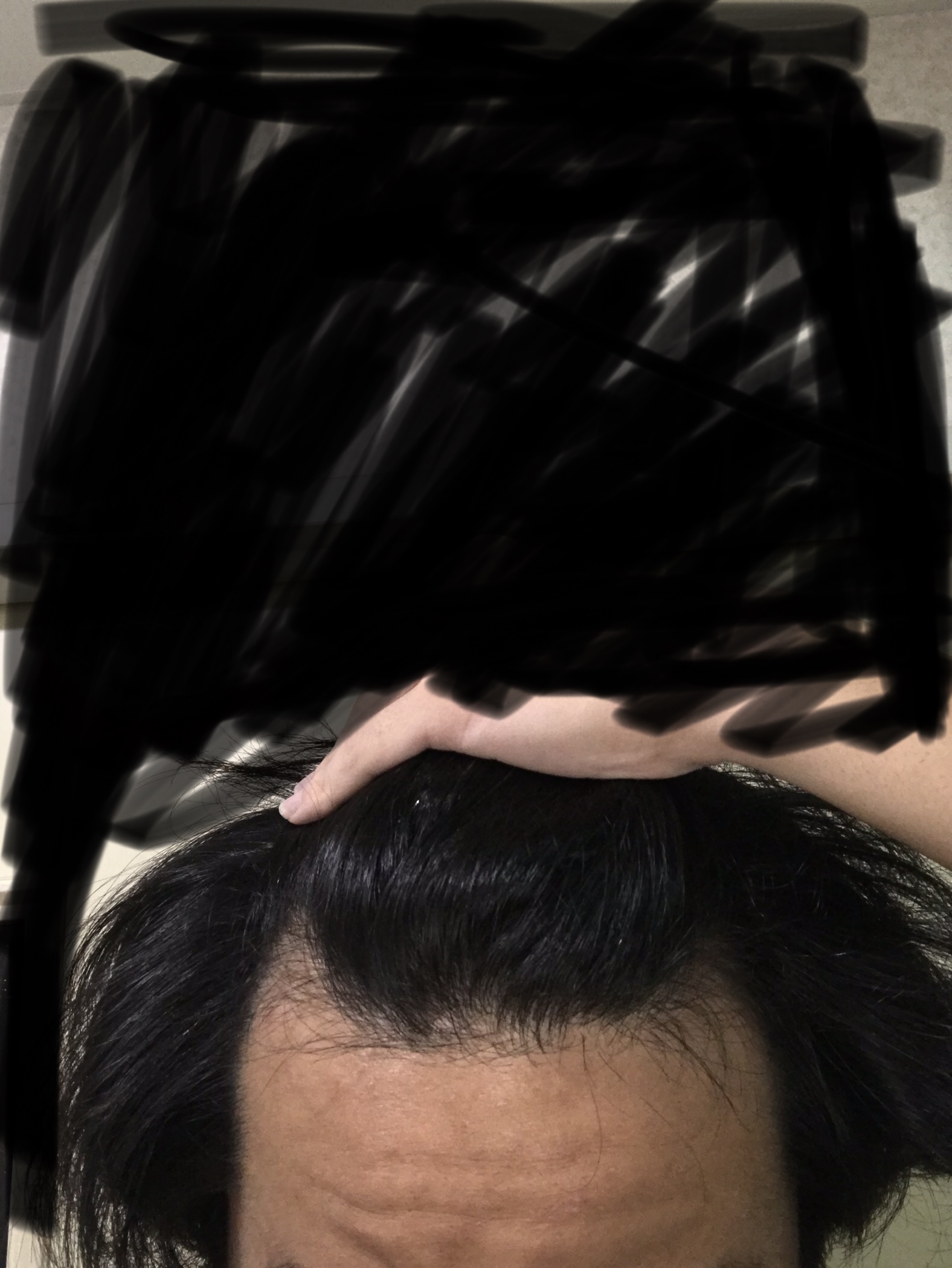 植毛 自毛植毛なんでも相談室 植毛ブログ 薄毛の疑問にお答えします