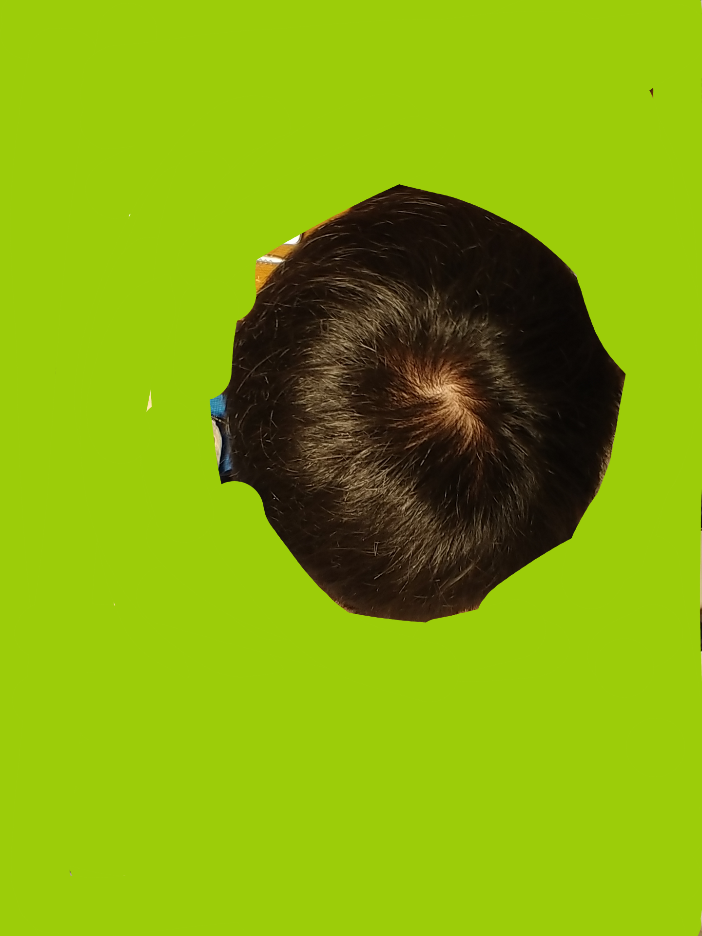 つむじについて 植毛 自毛植毛なんでも相談室 植毛ブログ 薄毛の疑問にお答えします