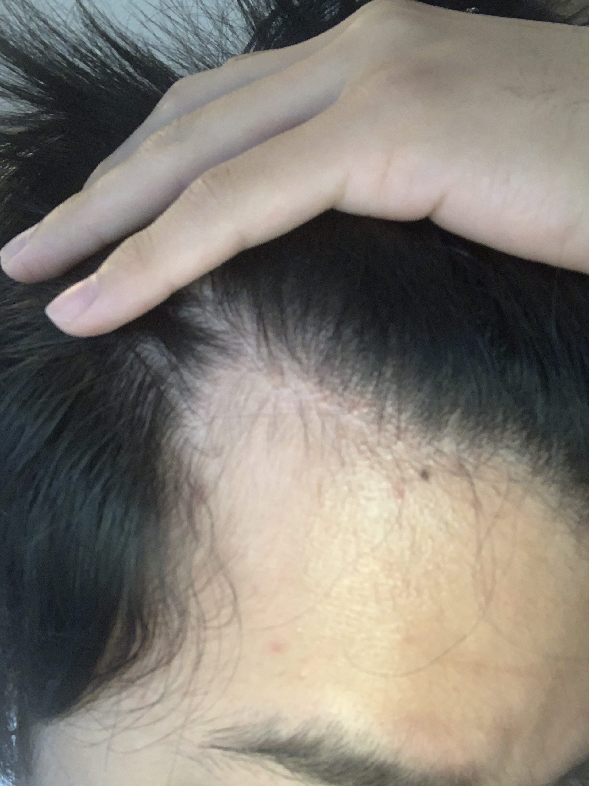 植毛 自毛植毛なんでも相談室 植毛ブログ 薄毛の疑問にお答えします