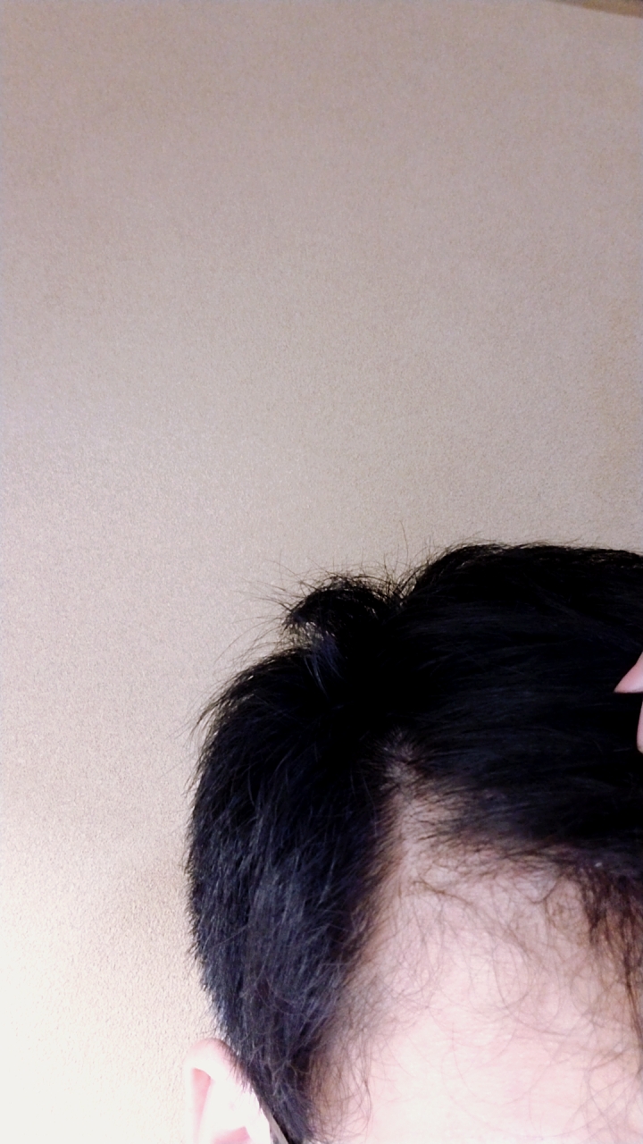 M字 植毛 自毛植毛なんでも相談室 植毛ブログ 薄毛の疑問にお答えします