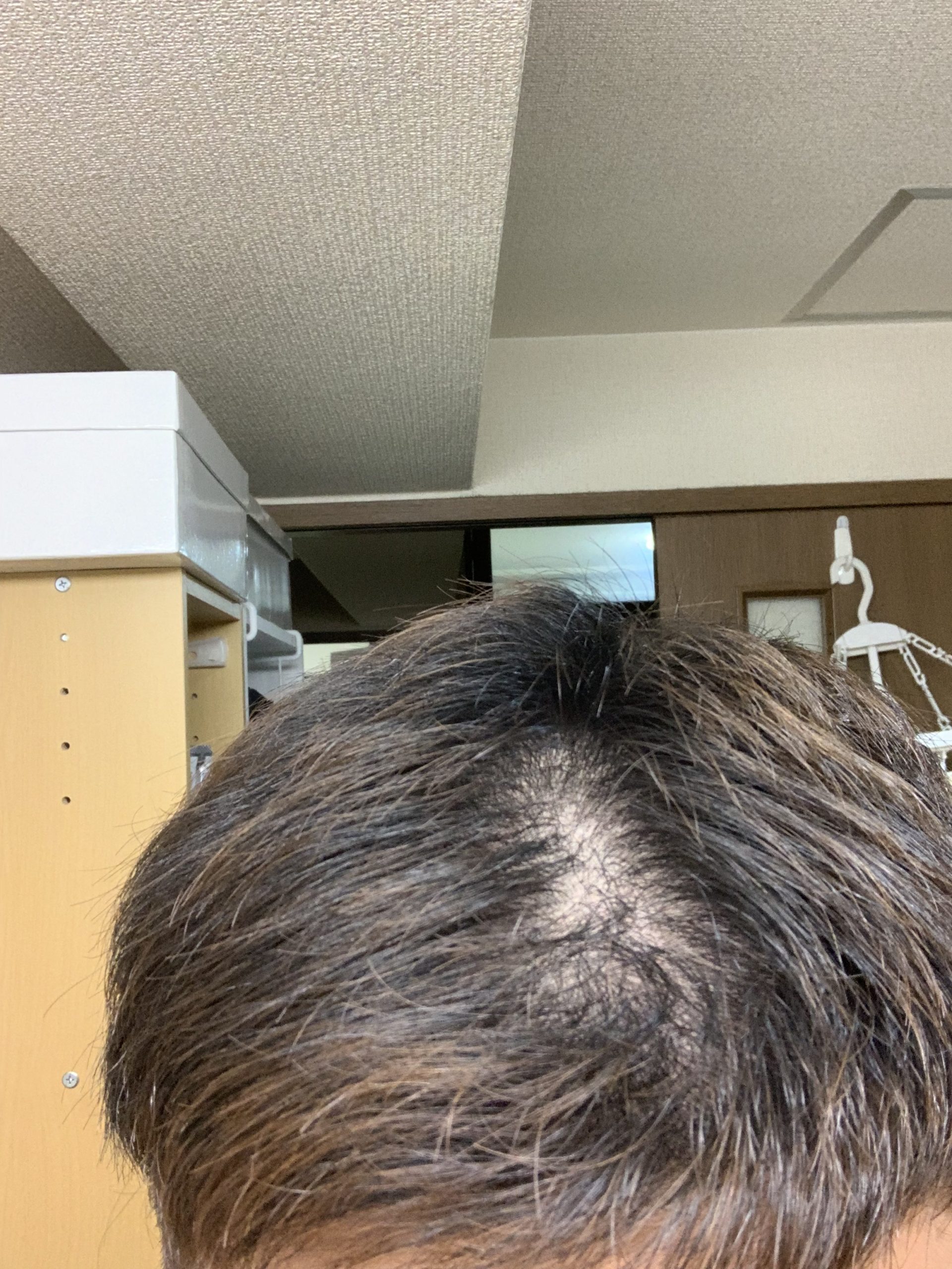 植毛 自毛植毛なんでも相談室 植毛ブログ 薄毛の疑問にお答えします