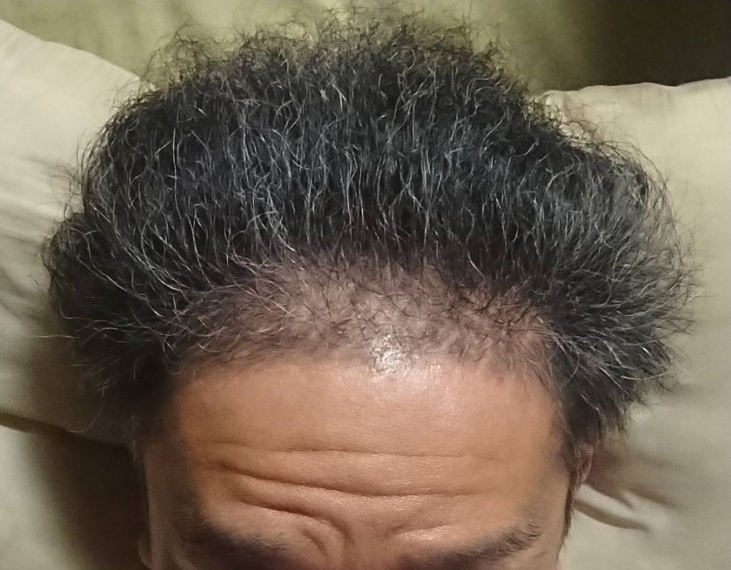 既存毛がほぼ産毛状態の場合の植毛の考え方 植毛 自毛植毛なんでも相談室 植毛ブログ 薄毛の疑問にお答えします