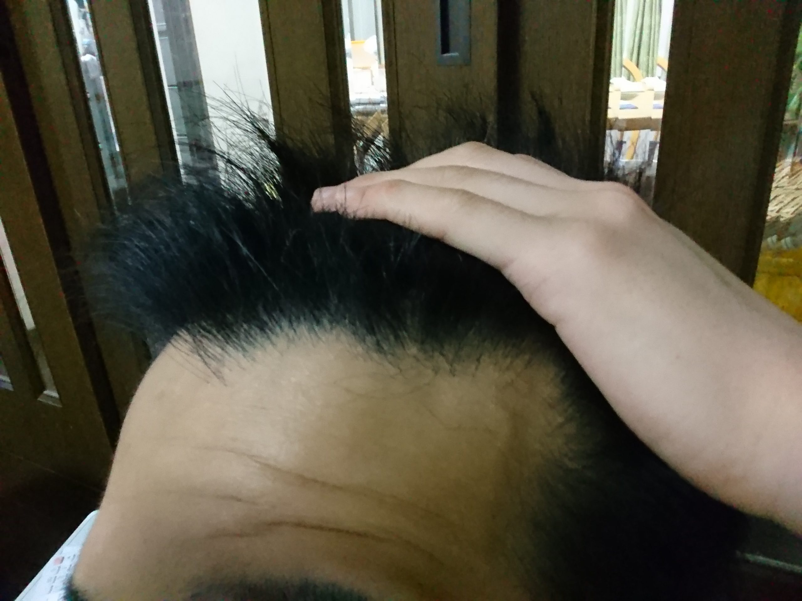 目安のグラスト数について 植毛 自毛植毛なんでも相談室 植毛ブログ 薄毛の疑問にお答えします