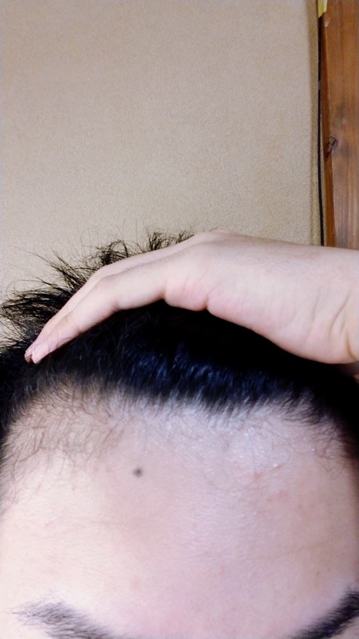 M字 植毛 自毛植毛なんでも相談室 植毛ブログ 薄毛の疑問にお答えします