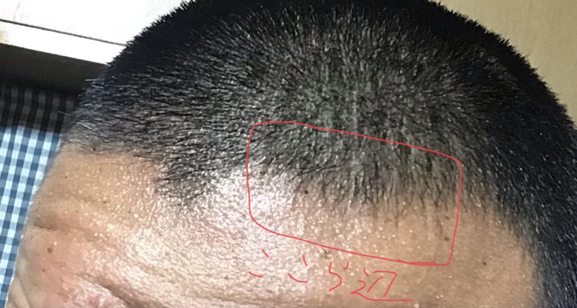 植毛 自毛植毛なんでも相談室 植毛ブログ 薄毛の疑問にお答えします