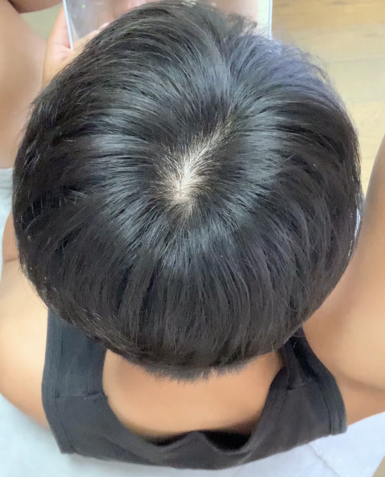 質問と相談 植毛 自毛植毛なんでも相談室 植毛ブログ 薄毛の疑問にお答えします